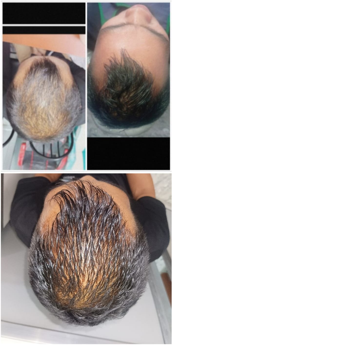 PRP/GFC treatment to prevent hairfall